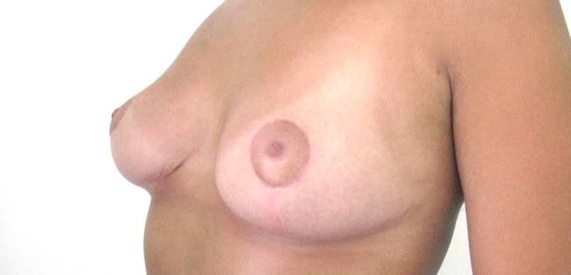 After breast asymmetry procedure to make breast even